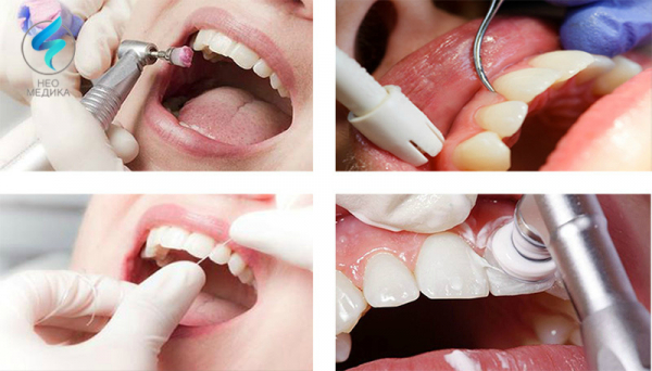 Снятие зубных отложений Томск Омская Лечение периостита Томск Лесной 3-й