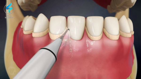 Снятие зубных отложений Томск Китайский клиники профилактической стоматологии мастер дент томск